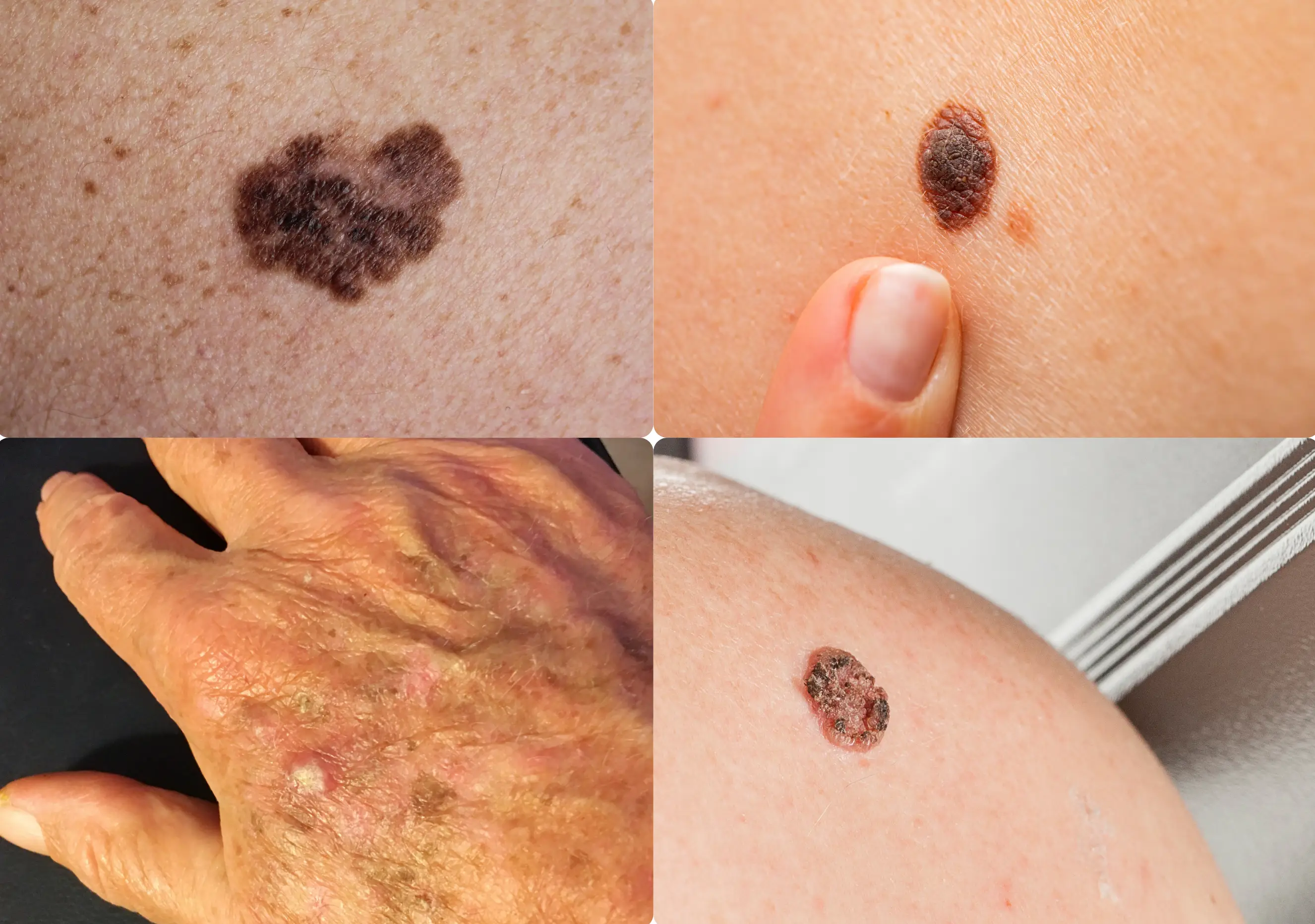 Cáncer de Piel - Melanoma