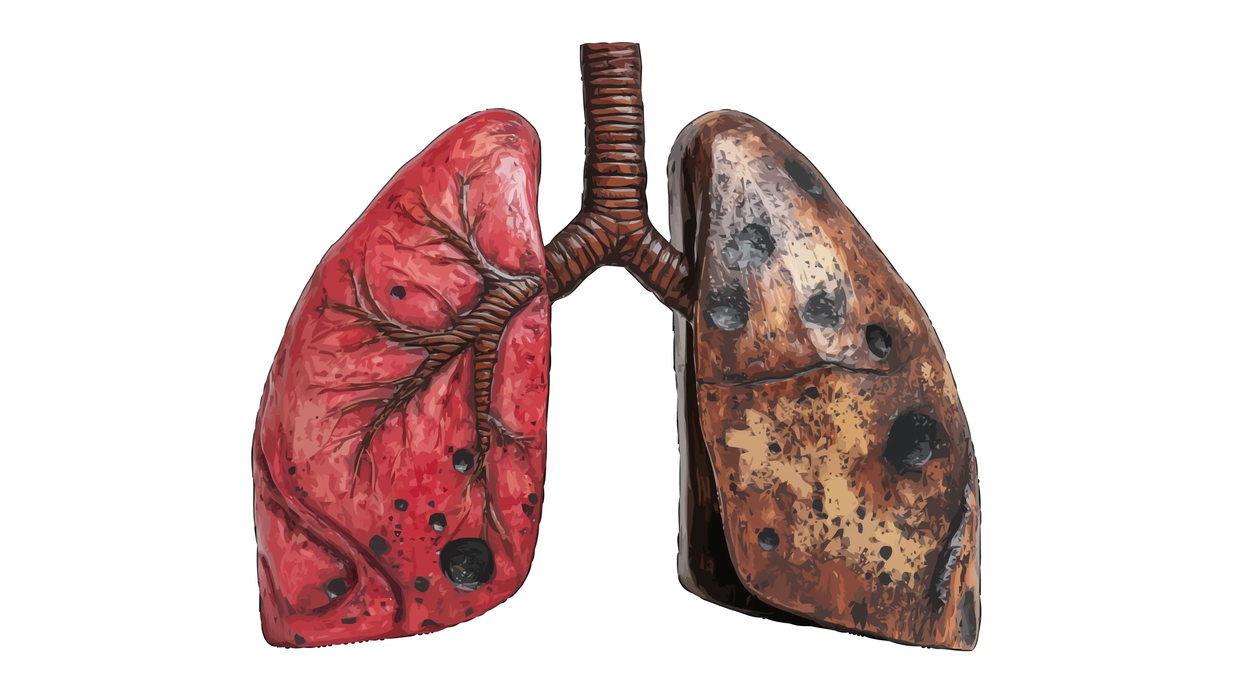 Cáncer  Respiratorio