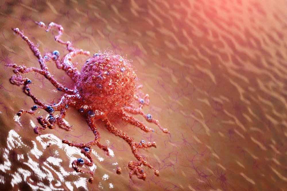 Tumores de hueso, músculo y tejidos blandos en Querétaro: Diagnóstico y tratamiento oncológico especializado