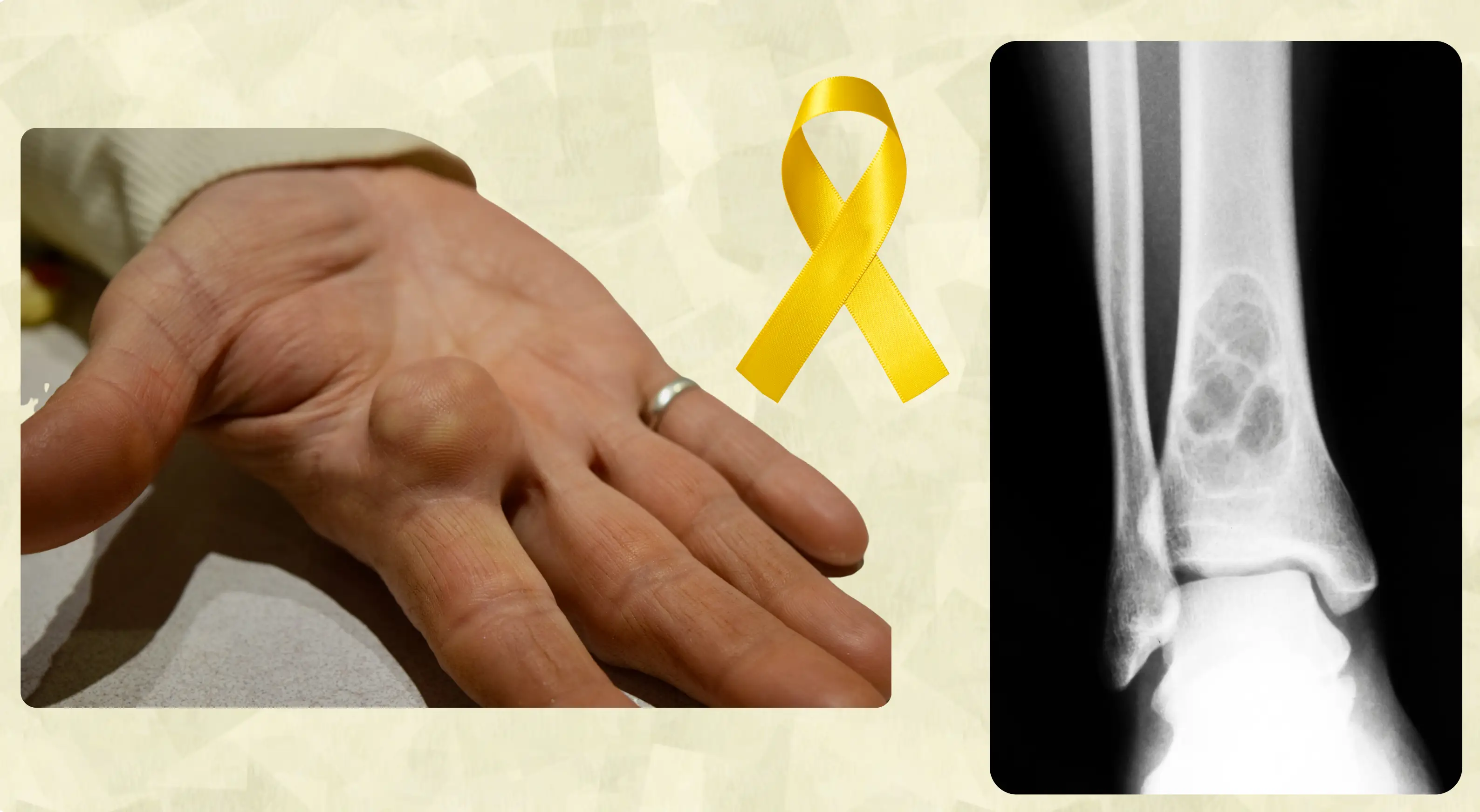 Tumores óseos y de Partes Blandas